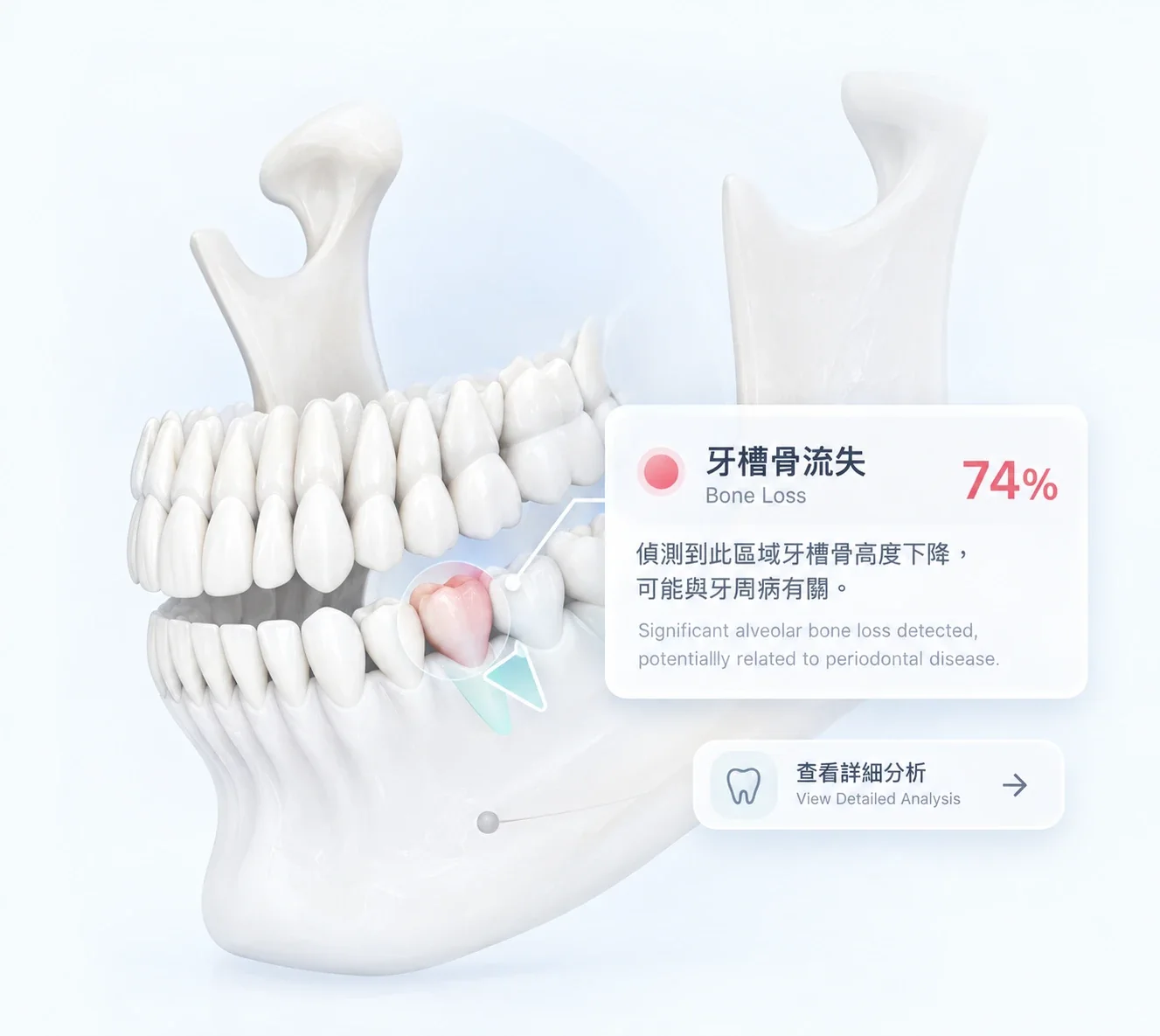 下顎骨連同整排牙齒的立體圖,其中一處牙槽骨以粉紅色標示並用箭嘴指出;旁邊的說明指此區域牙槽骨高度下降,可能與牙周病有關。