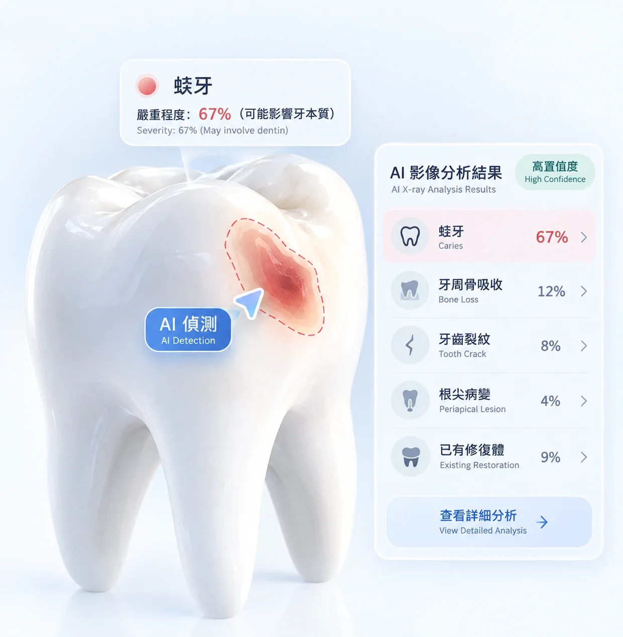 一隻臼齒的立體圖,咬合面上一處蛀壞以紅色虛線圈出,旁邊標示為 AI 偵測;右邊一欄逐項列出 AI 影像分析結果——蛀牙、牙周骨吸收、牙齒裂紋、根尖病變、已有修復體,每項各有一個百分比。
